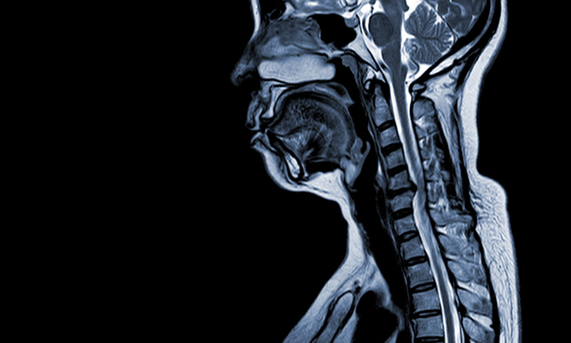 Anterior Cervical Discectomy
