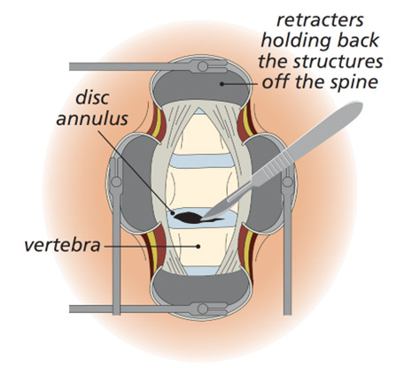 Anterior Cervical Discectomy