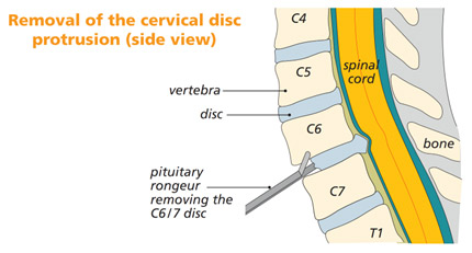 Spine MDT