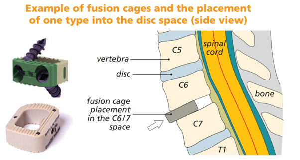 Anterior Cervical Discectomy