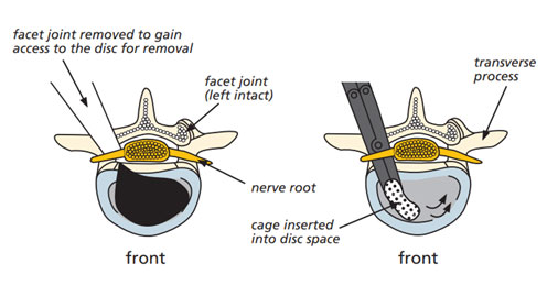 Executing Minimally Invasive Lumbar Interbody Fusion