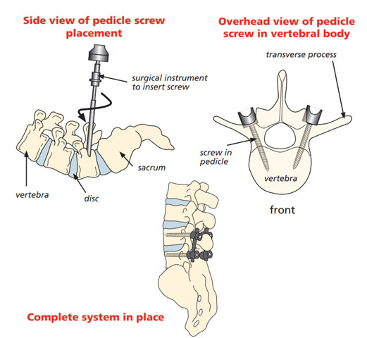 Fused spine with screws and cage