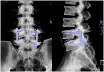 Final x ray of fused spine with screws and cage.