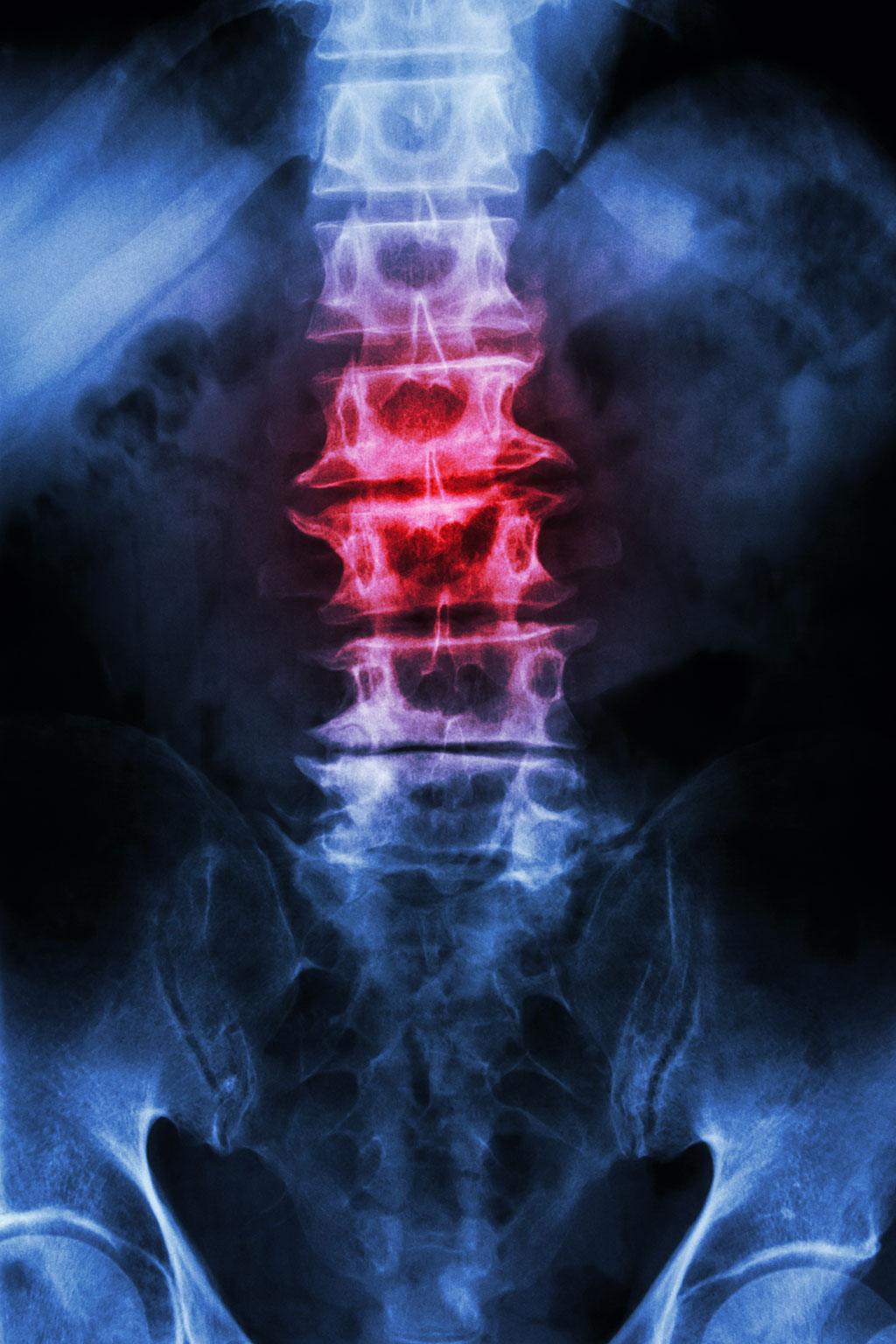 Back Pain