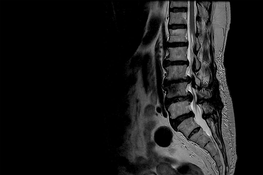 Understanding IDD Therapy