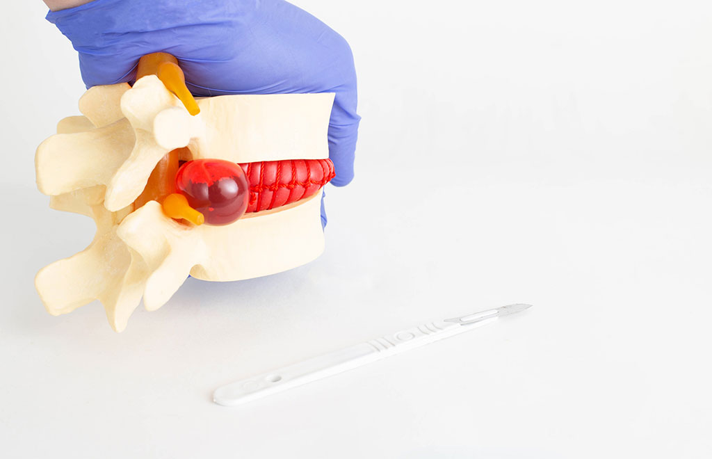 IDD therapy in managing various spine conditions