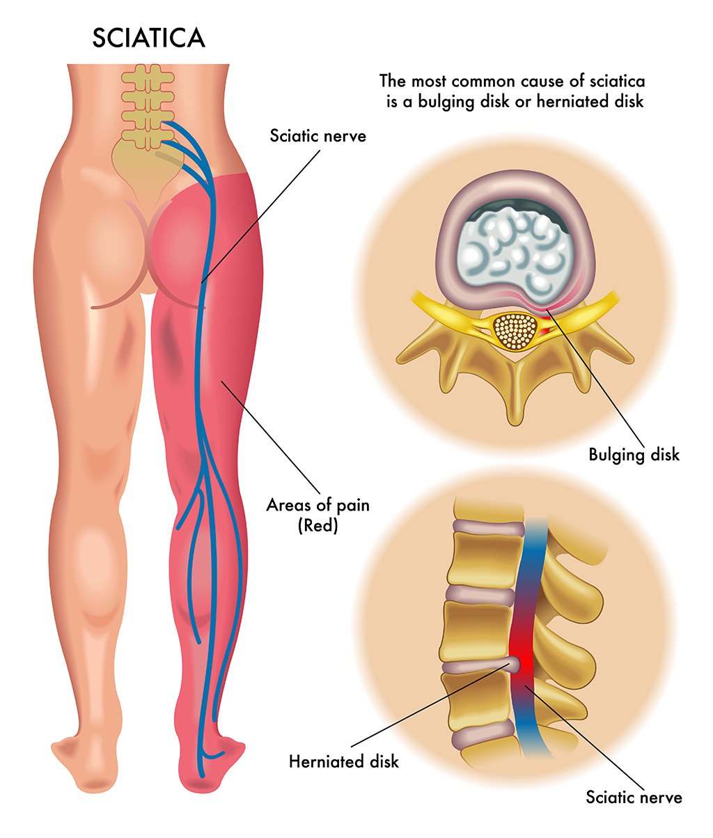 Herniated Disc