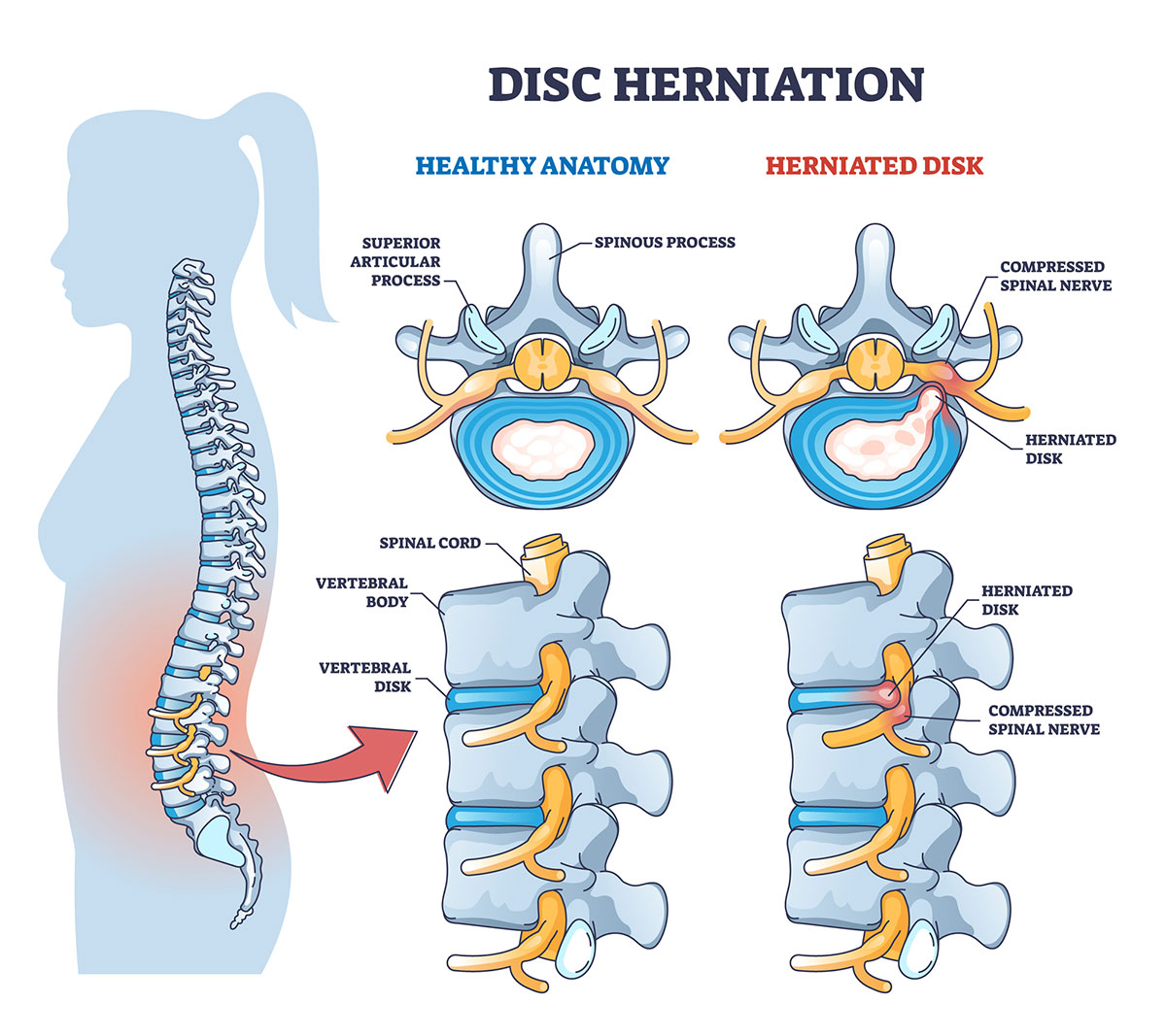 Lumbar microdiscectomy