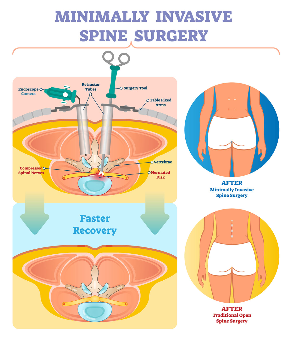 Lumbar microdiscectomy
