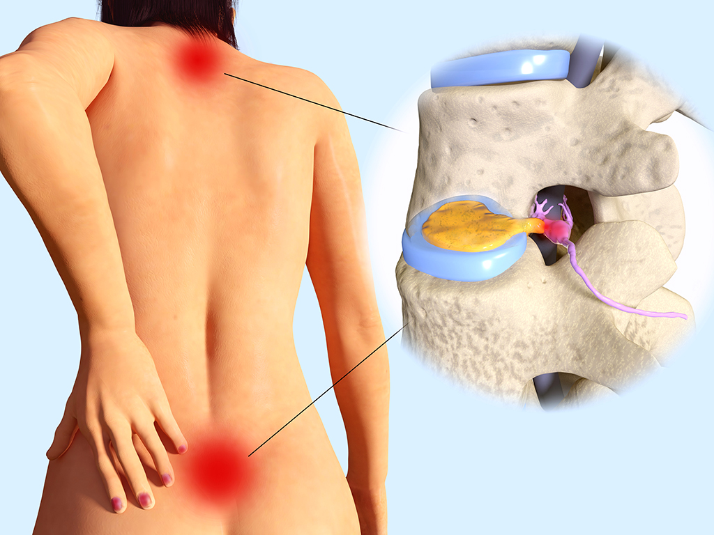Back pain