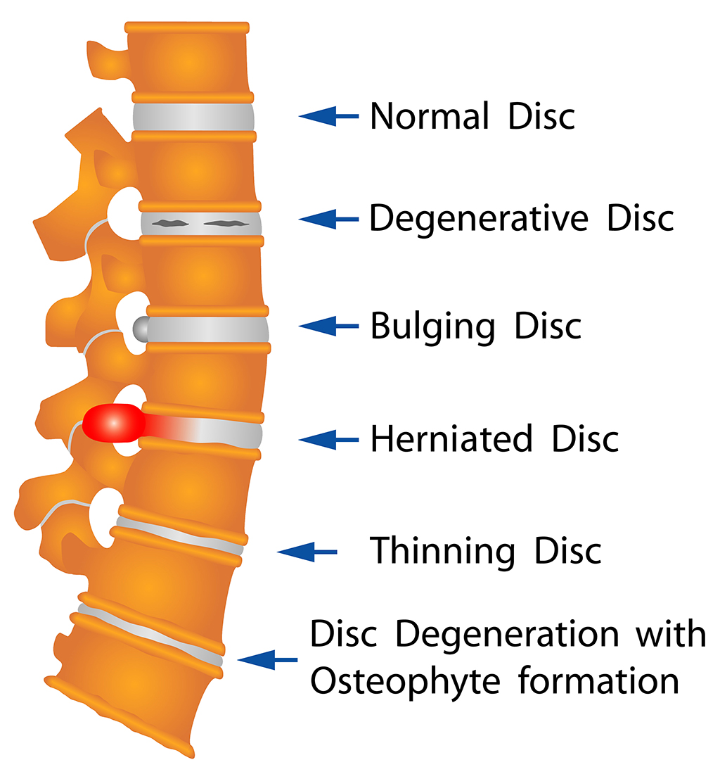 Back pain