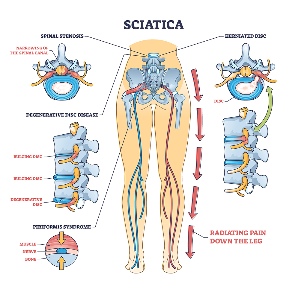 Back pain