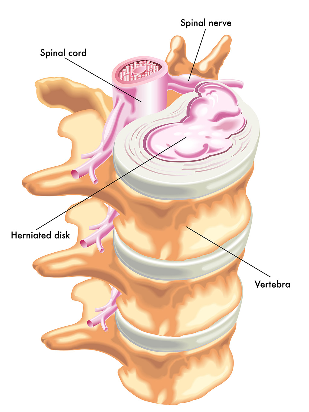 Home after a lumbar discectomy