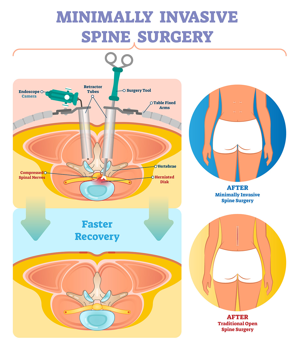 Spinal Stenosis