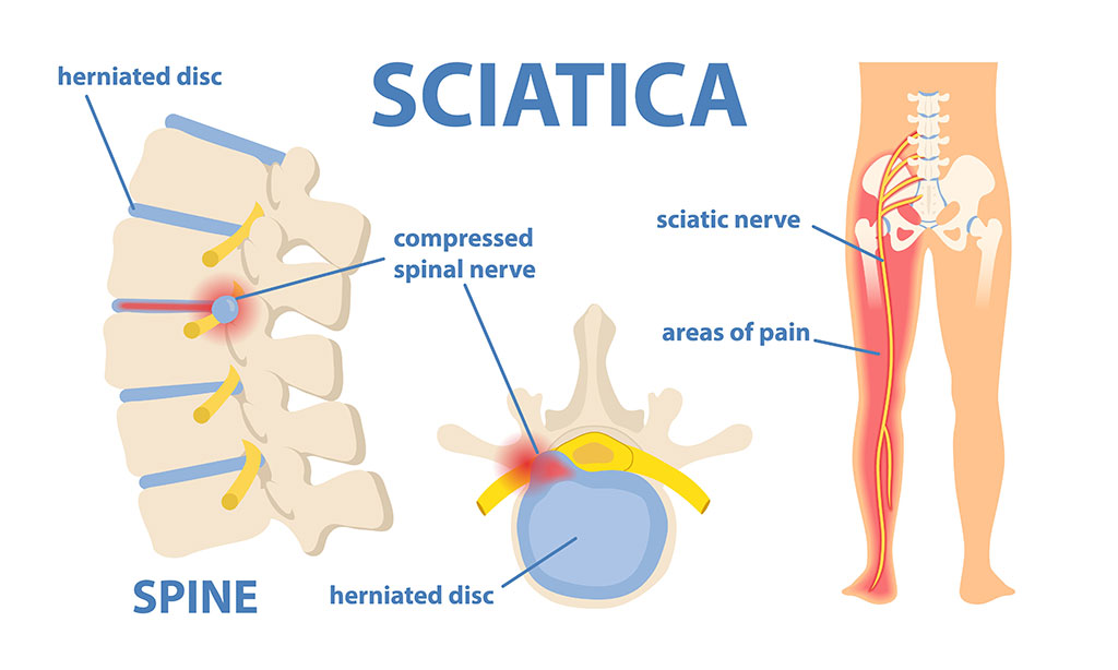 Microdiscectomy