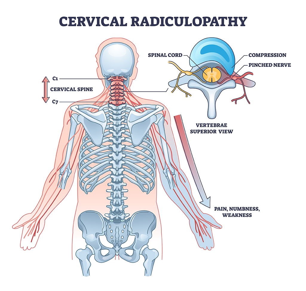 Cervical foraminotomy